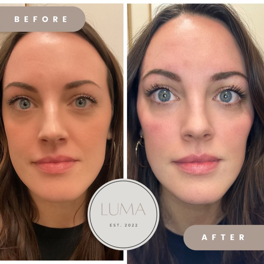 Before and After Sculptra treatment | LUMA Medical Aesthetics in Glenwood Springs, Co