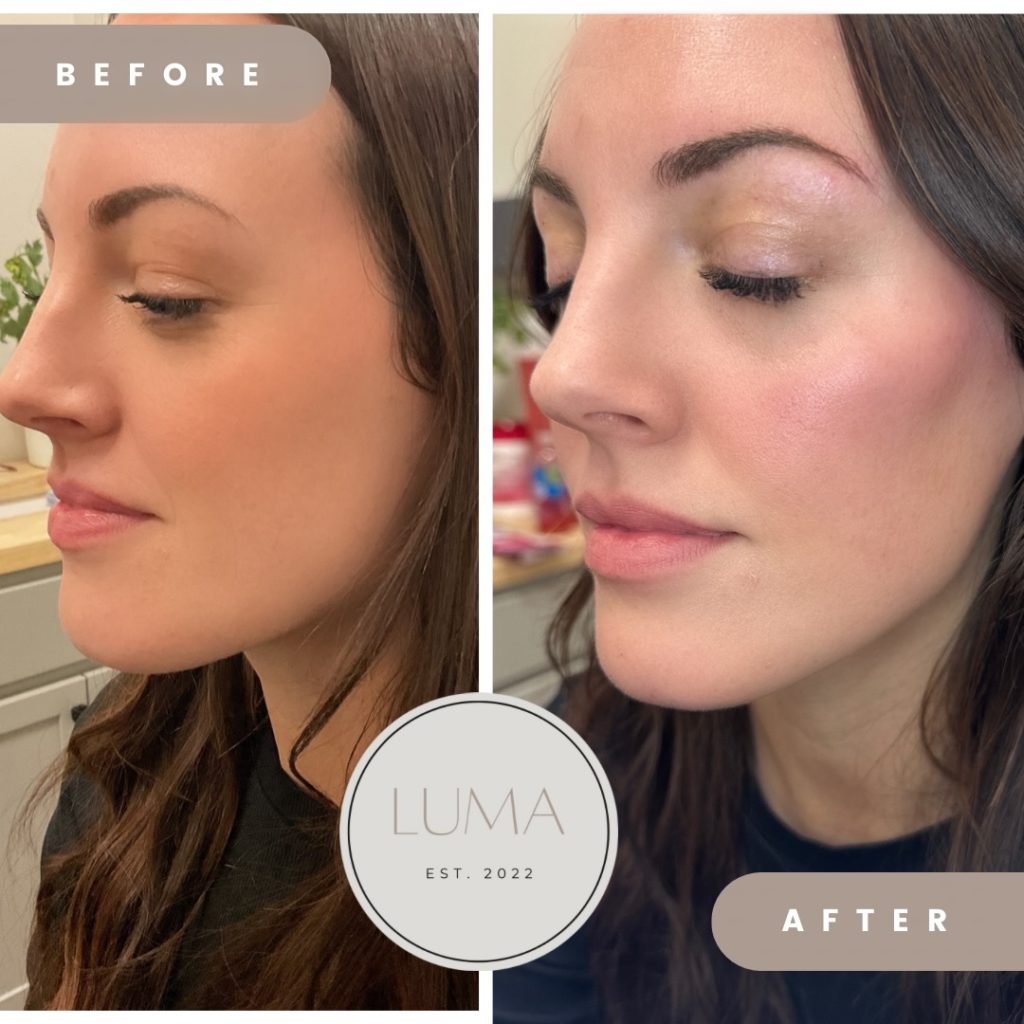 Before and After Sculptra treatment | LUMA Medical Aesthetics in Glenwood Springs, Co