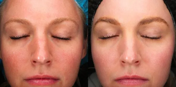 AdvaTX Laser Treatment Before and After | LUMA Medical Aesthetics in Glenwood Springs, Co
