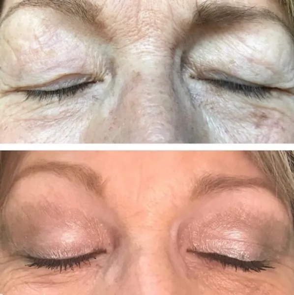Jet Plasma before and After | LUMA Medical Aesthetics in Glenwood Springs, Co