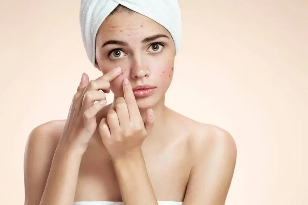 Acne Facial Treatment at LUMA Medical Aesthetics