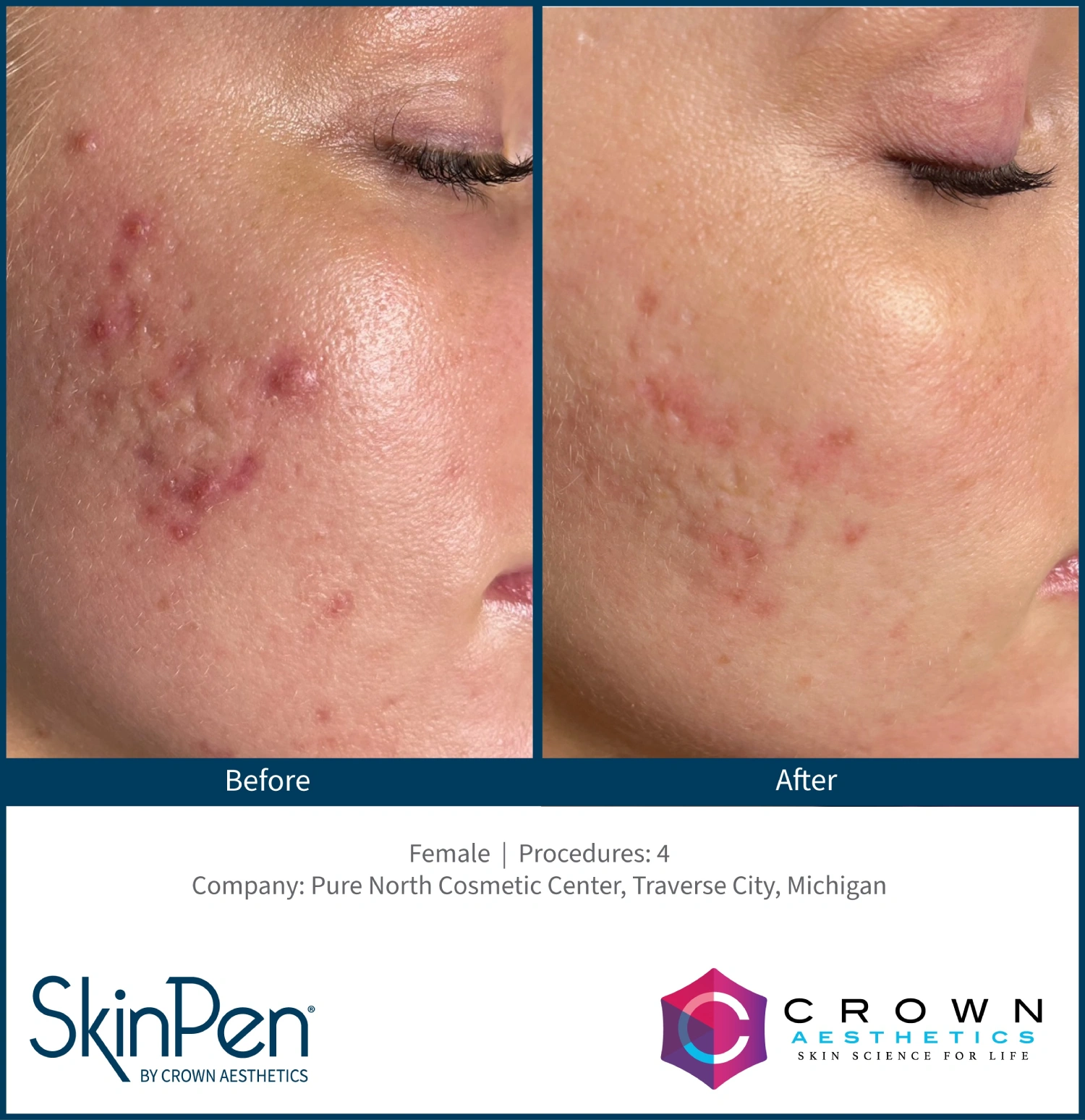 lumamedicalaesthetics skinPen® Elite microneedling before and after