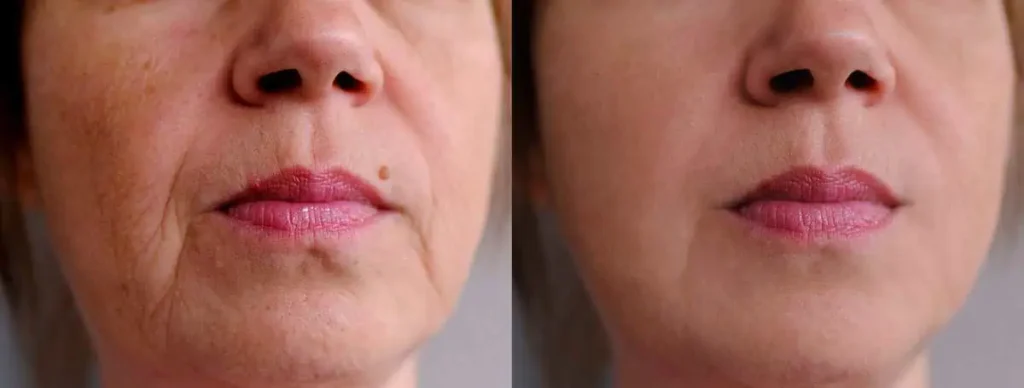 HALO® Glenwood by LUMA Medical Aesthetics