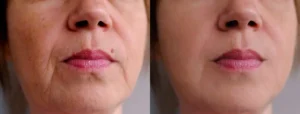 HALO® Glenwood by LUMA Medical Aesthetics