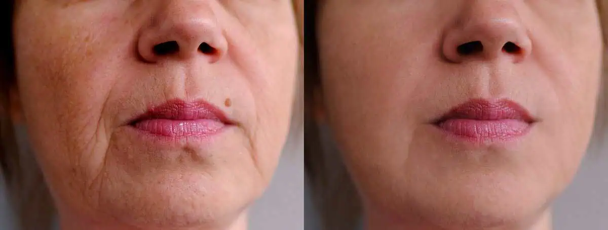 HALO® Glenwood by LUMA Medical Aesthetics