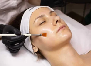 Chemical Peels in Glenwood Springs by LUMA Medical Aesthetics