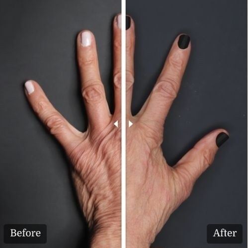 Renuva® for Natural-Looking Volume Restoration 2