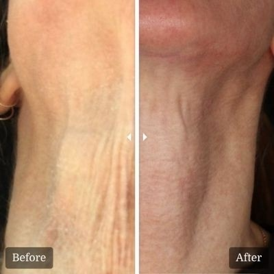 Renuva® for Natural-Looking Volume Restoration 3